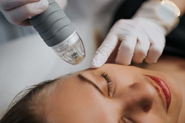 Microneedling