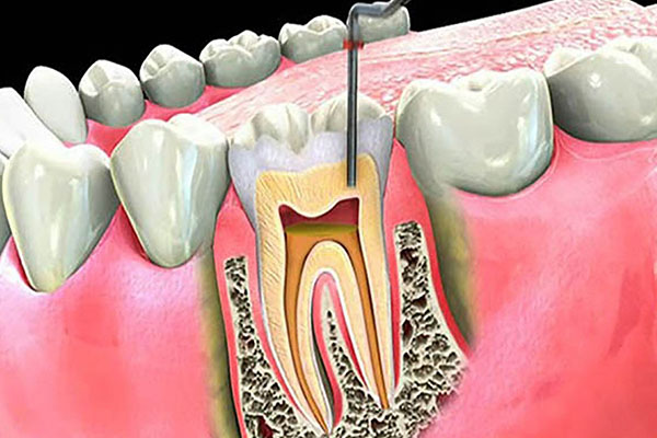 ENDODONCIA