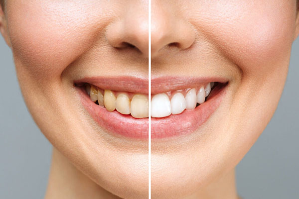 ESTÉTICA DENTAL
