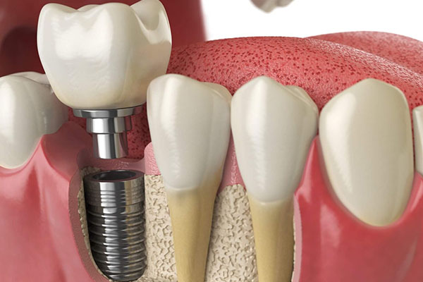 IMPLANTES Y CIRUGÍA DENTAL