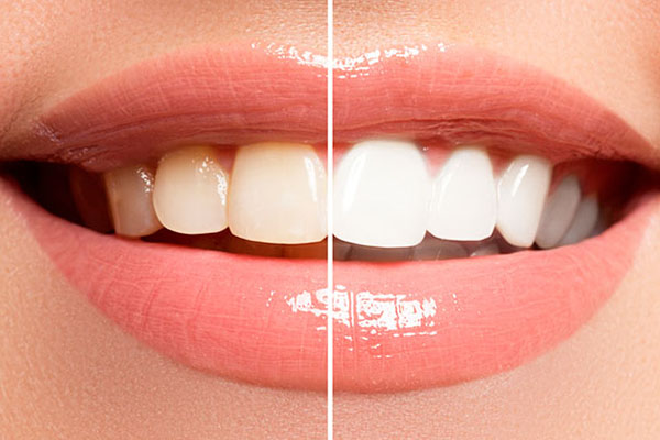 CARILLAS DENTALES