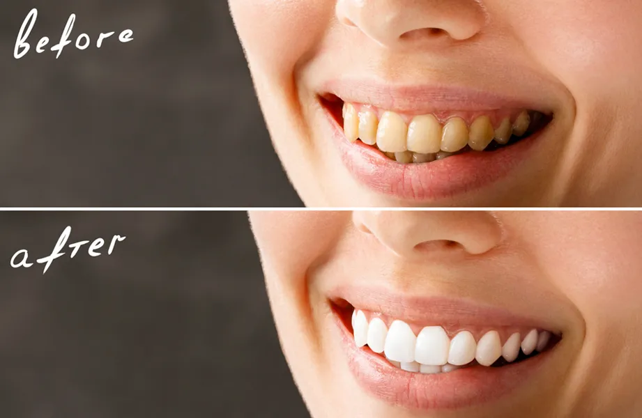 Blanqueamiento Dental