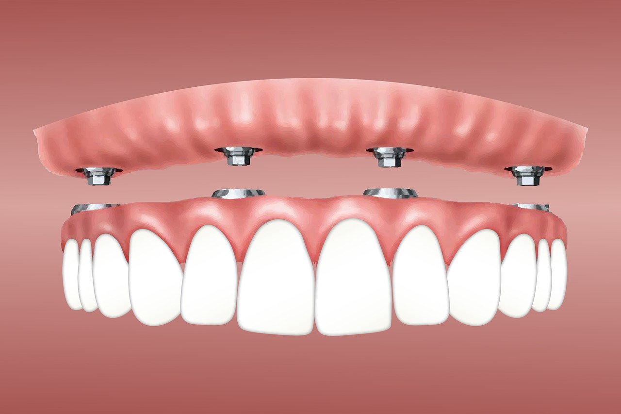 Dentadura fija sobre 4 implantes