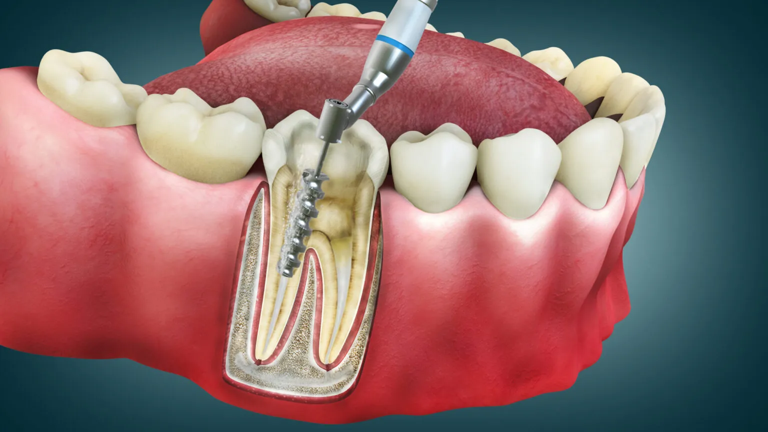 Endodoncia