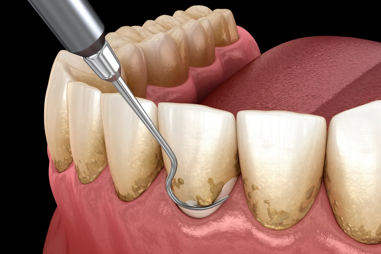 Limpieza dental