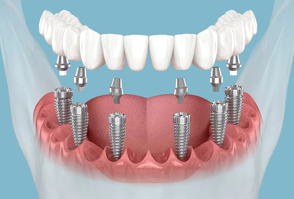 Prótesis Fija sobre Implantes Dentales